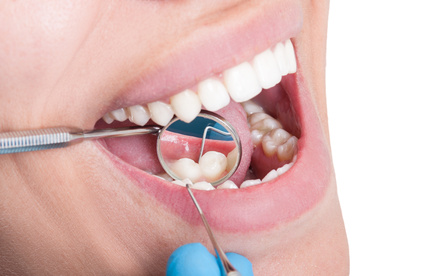 歯のクリーニングの画像