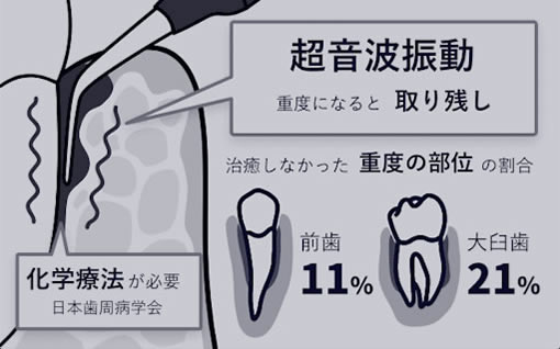 歯の表面のクリーニング