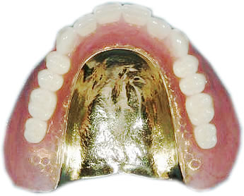 金属床義歯総入れ歯