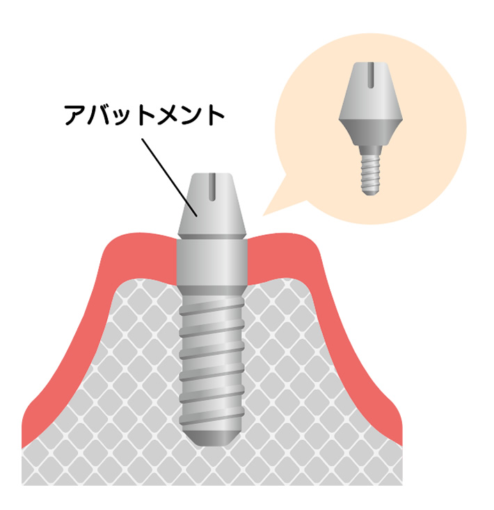 画像：インプラント治療開始（一次手術）