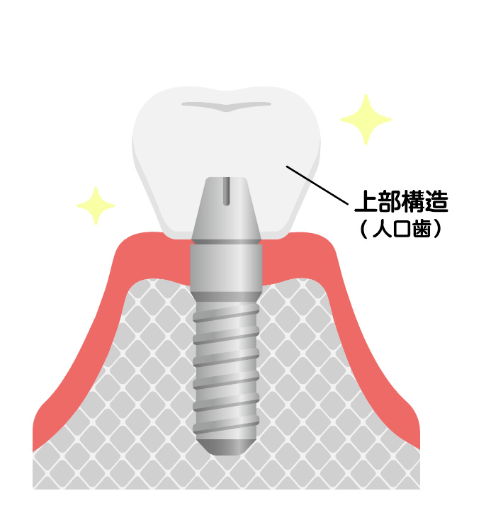 画像：インプラント装着（二次手術）