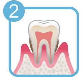 画像：歯周病の進行レベル