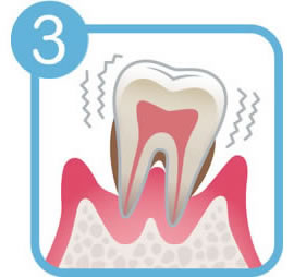 画像：歯周病の進行レベル