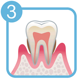 中等度の歯