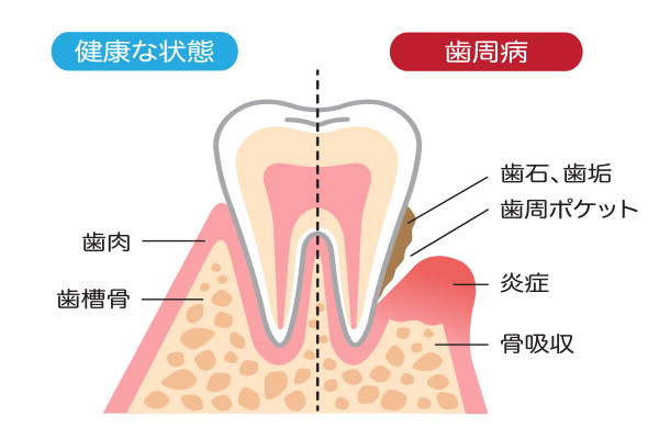 画像：歯周病