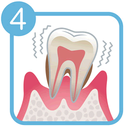 重度の歯