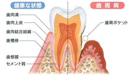 歯周病画像